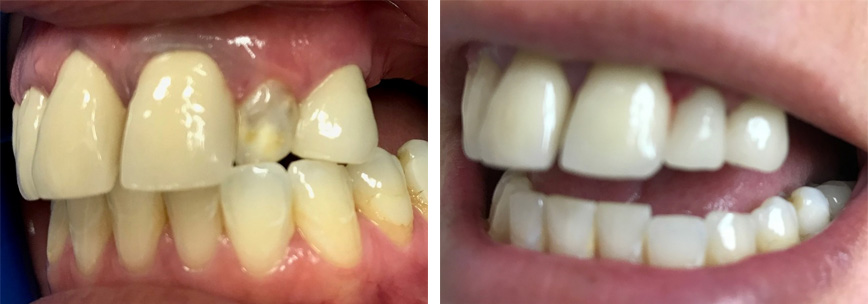 Root Canal and Same-Day Crown