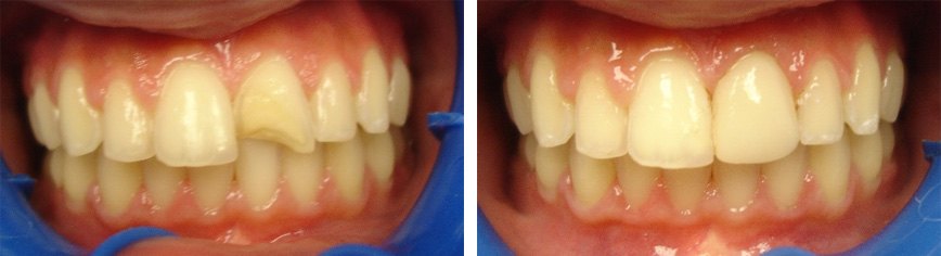 CEREC Same-Day Dentistry