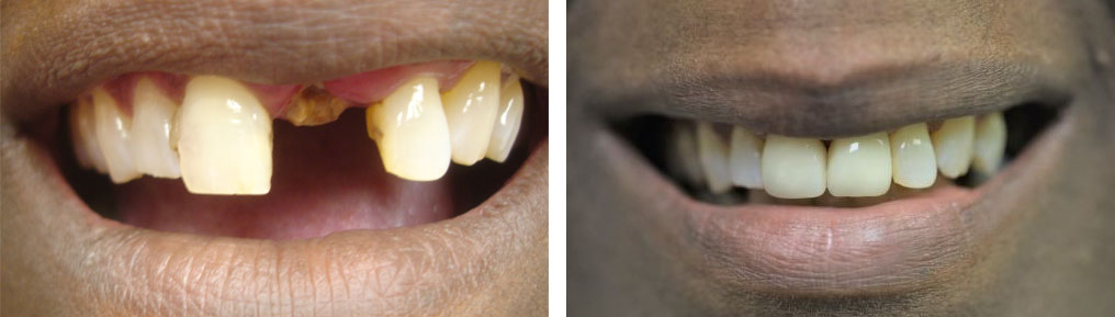 Dental Implants Case 2