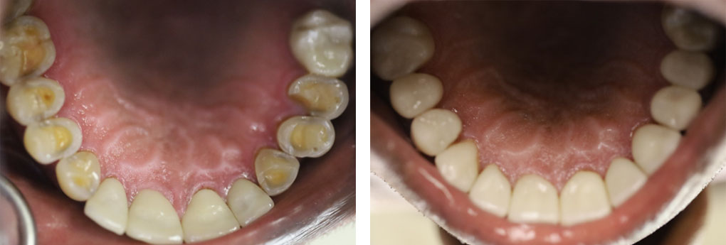 Full Mouth Restoration #1