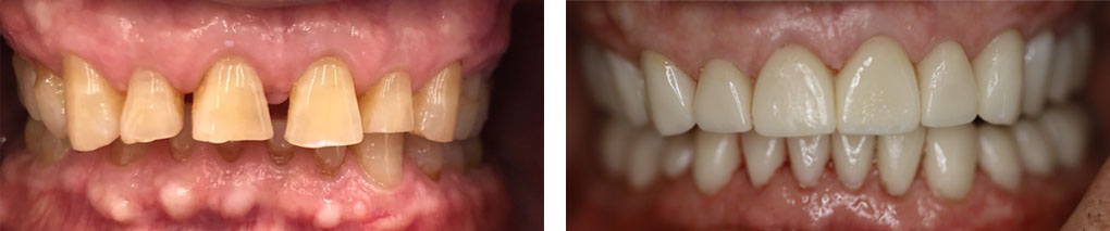 Full Mouth Restoration #3