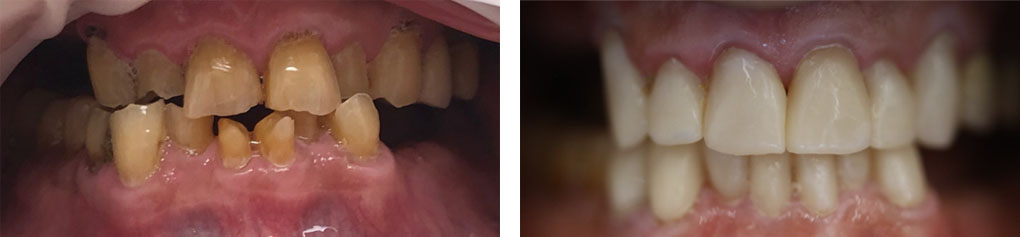 Full Mouth Restoration #5