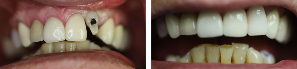 Implant Dentistry Case 2