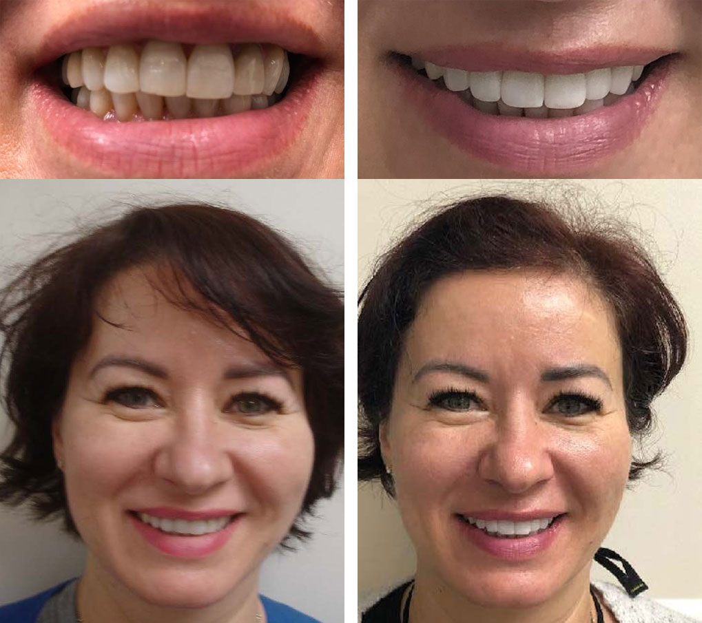 Smile Makeover Case 1