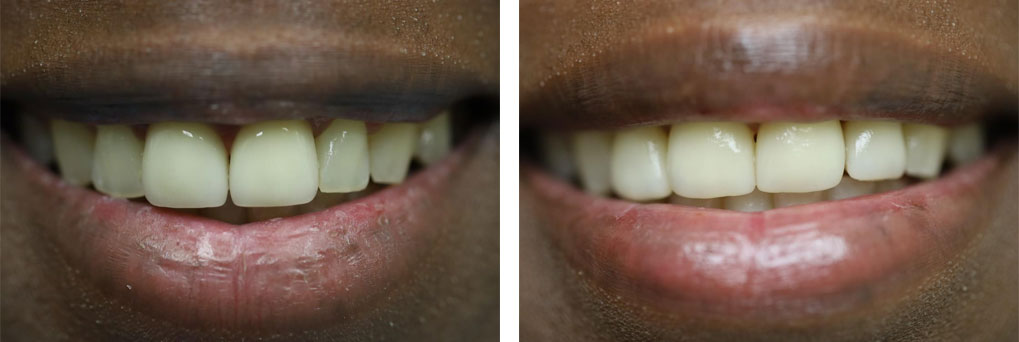 Same-Day Veneers Smile Makeover Case 5