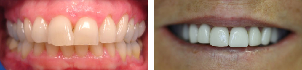 Smile Makeover Case 7