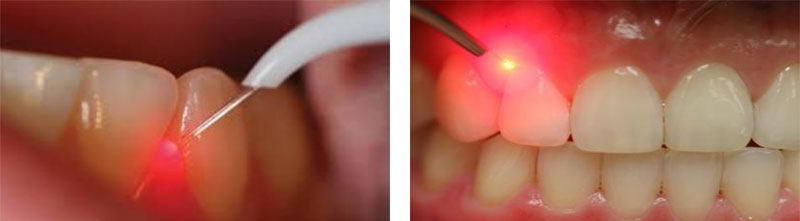 Laser Dental Procedures | Dent Blanche Dental
